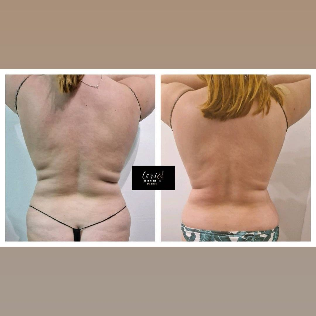 lipo-cavitation treatment result